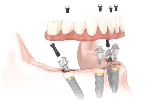 All-on-4 Treatment Concept